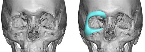 Custom Right Orbital Implant for Asymmetry design front view Dr Barry ...