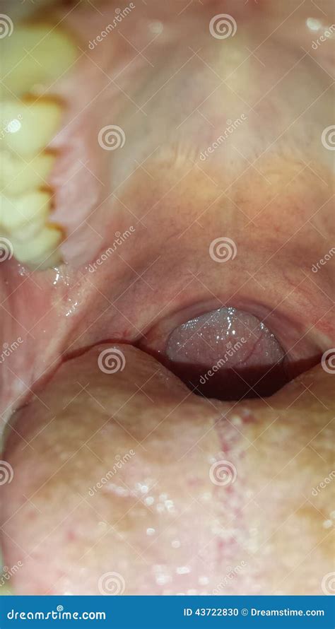 Beitrag Tonsillektomie Uvulopalatopharyngoplasty Stockfoto Bild Von