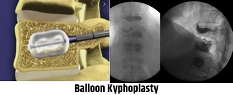 Balloon kyphoplasty/Vertebroplasty/Sacroplasty – Dr. Saurabh Kapoor