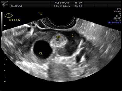 Corpus Luteum Ultrasound