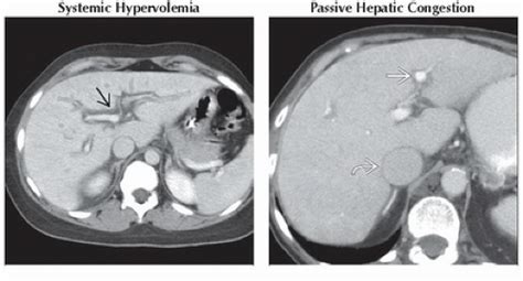 DA9-DB2-Periportal_Lucency_or_Edema-FFU3.gif | Abdominal Key