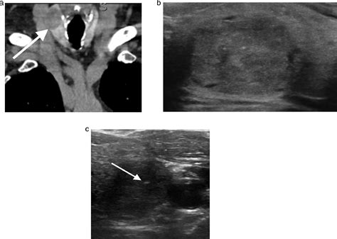 Ultrasound Guided Thyroid Biopsy Techniques In Vascular And Interventional Radiology