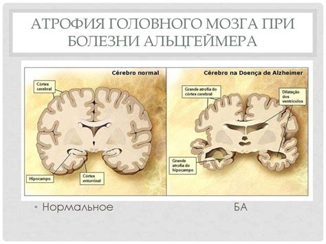 Деменция. Классификации деменций - презентация онлайн