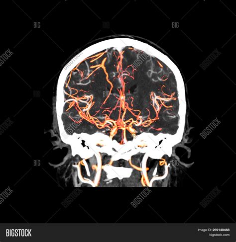 Ct Angiography Brain Image Photo Free Trial Bigstock