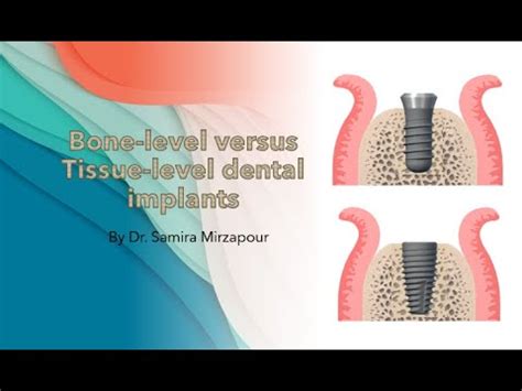 Bone Level Versus Tissue Level Dental Implants YouTube