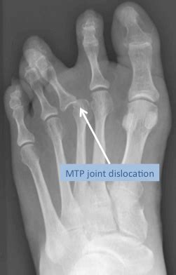 MTP Joint Dislocation | Mr Malik Orthopaedic Consultant