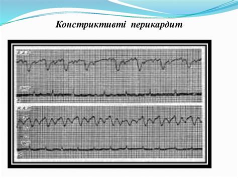 Перикардиттердің ЭКГ көріністері - презентация онлайн