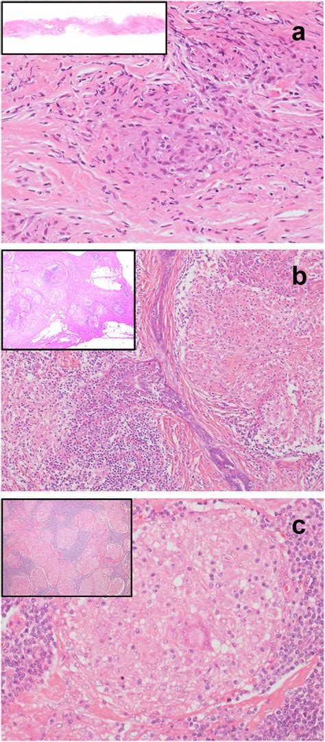 Histology Of The Core Needle Biopsy And Open Breast Biopsy Specimens Download Scientific