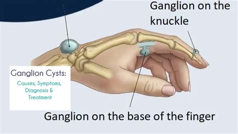 Everything You Need To Know About Ganglion Cysts Causessymptoms