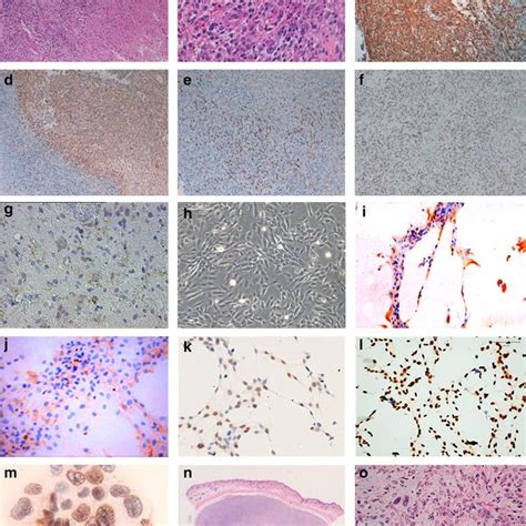 Histology of the glioblastoma: a H&E (×4). The tumor showed ...