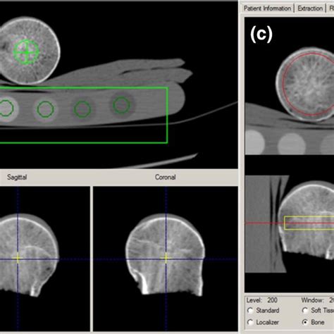 Quantitative Computed Tomography Qct In The Steps A Extraction B