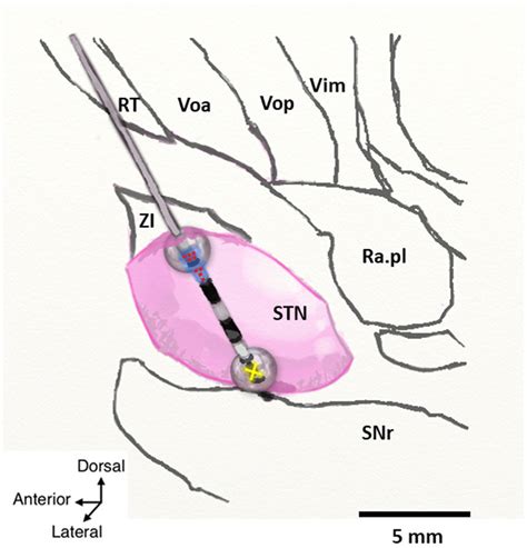 Schematic Of A Sagittal View Of The Subthalamic Nucleus Stn And A