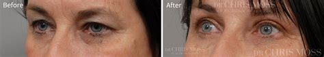 Eyelid Surgery Before And After Dr Chris Moss Plastic Surgeon