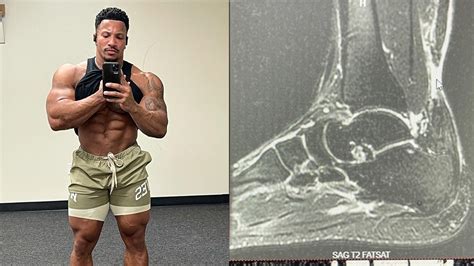 Bodybuilder Patrick Moore Gives Update On Achilles Tendon Injury That ...