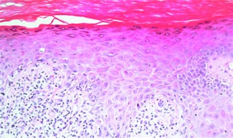 Histopathology Of Clp There Is Hyperkeratosis And Hypergranulosis In