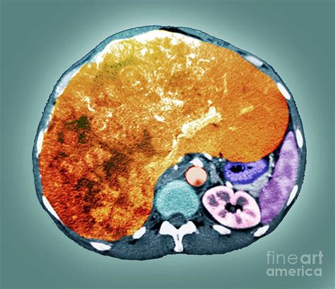 Liver Cancer Photograph By Zephyr Science Photo Library Fine Art America