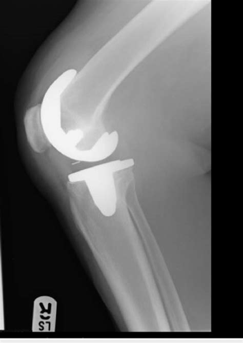 One year postoperative X-ray, lateral view | Download Scientific Diagram