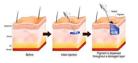 Immune Responses To Tattoos