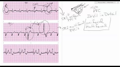 Multifocal Premature Ventricular Contractions