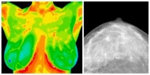 Breast Thermography vs. Mammogram - Holistic Squid