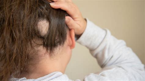 Alopecia Conhe A As Causas E O Tratamento Da Condi O Alto Astral