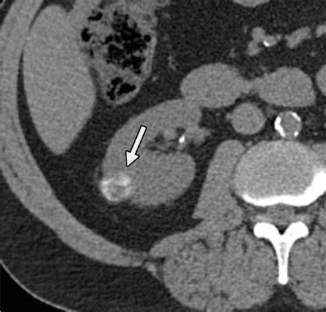 Diagnostic Approach To Benign And Malignant Calcifications In The