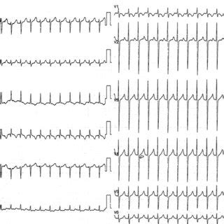 Twelve Lead Electrocardiogram Showing Regular Narrow QRS Tachycardia