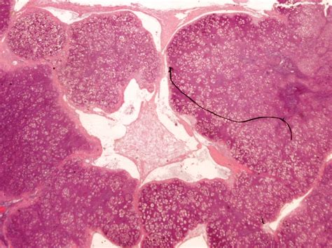 Malignant Mesothelioma Histology