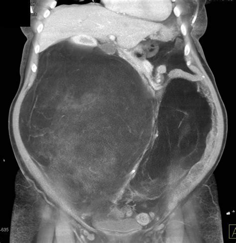 Liposarcoma Gastrointestinal Case Studies Ctisus Ct Scanning