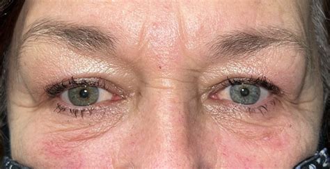 21 Upper Eyelid Surgery Before And After Photos Dallas Plano Texas Cosmetic Reconstructive