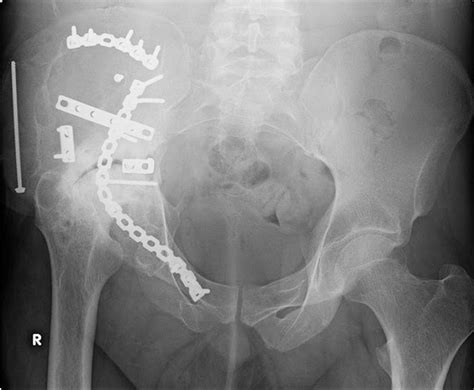 Sacral Fracture Treatment | Sacral Bone Fracture Surgery