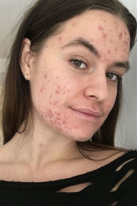 Acne Positive Strawberry Freckles Acne Girl Accutane Before And