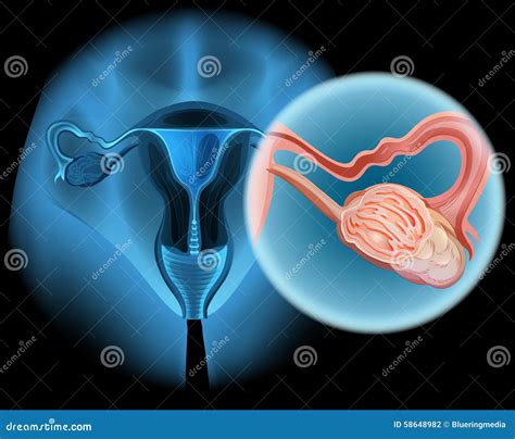 Ovarian Cancer Diagram In Woman Stock Vector Image 58648982