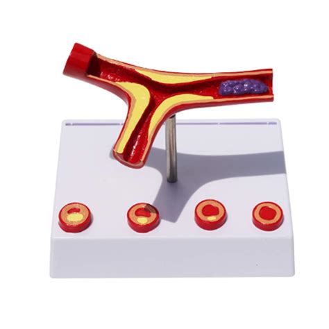 Buy Anatomy Atherosclerosis Model Thrombus Thrombosis Vascular Model