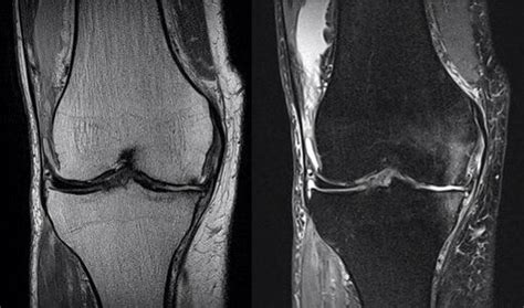 Fat Suppression Techniques For Mr Imaging Of The Musculoskeletal System