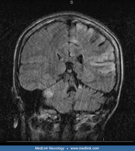 Rasmussen syndrome | MedLink Neurology