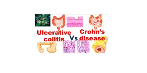 Ulcerative Colitis Vs Crohns Disease Pathology Made Simple