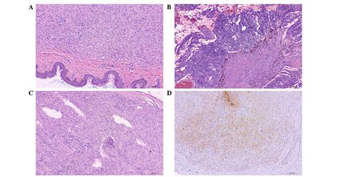 Neurofibromatosis Type 1 Associated With Pheochromocytoma And Gastrointestinal Stromal Tumors A