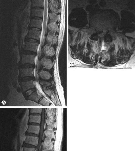 A 75 Year Old Man With L3 L4 And L4 L5 Spinal Stenosis A T2 Weighted