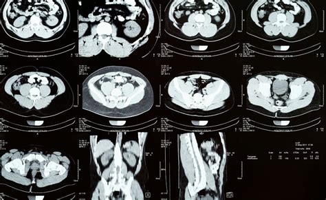 Tomograf A Abdominal En M Rida Cma Hospital