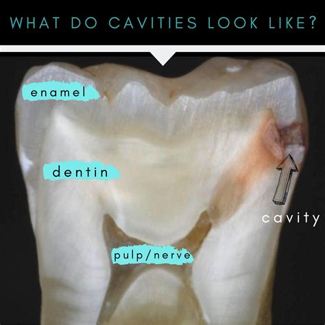 Cavities In Between Teeth