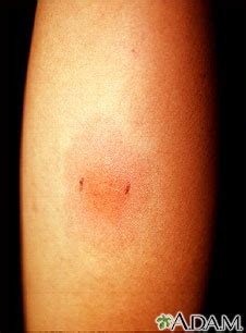 PPD skin test | UF Health, University of Florida Health