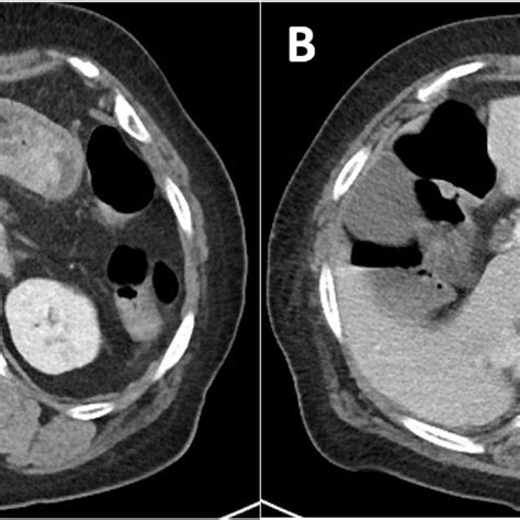 Preoperative Computed Tomography Findings A Computed Tomography Shows Download Scientific