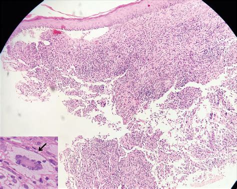 Dermoscopy Of Giant Juvenile Xanthogranuloma Indian Journal Of