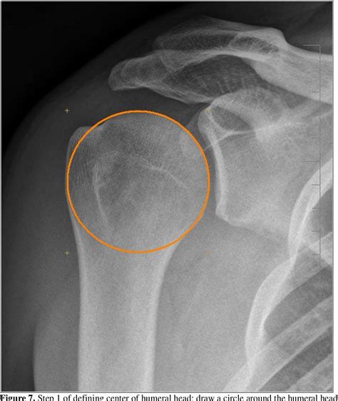 Radiographic Examination of Humeral Head Migration after Fatiguing the Rotator Cuff | Semantic ...