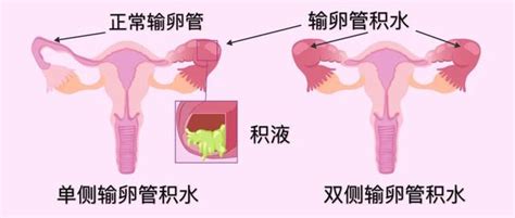 輸卵管積水「有毒」，會降低ivf成功率 每日頭條