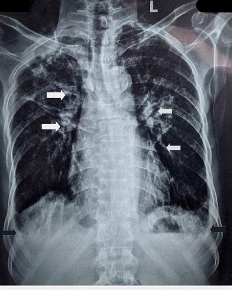 Chest X Ray PA View Few Patchy Areas Of Ground Glass Opacities In B L