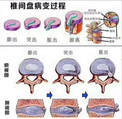 腰椎间盘膨出、突出、脱出，什么情况就要治疗了？ 腰椎间盘 纤维环 病理性 治疗 症状 神经 健康界