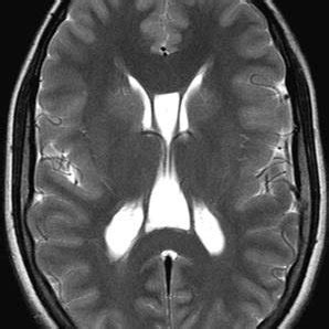 A B Transverse T Weighted Tr Te Ms Turbo Spin Echo Mr