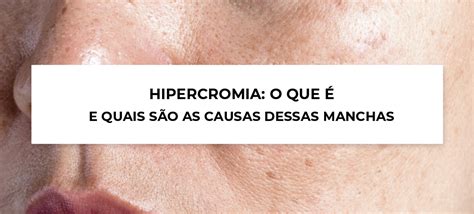 HIPERCROMIA O QUE É E QUAIS SÃO AS CAUSAS DESSA MANCHA Blog Ada Tina